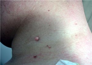 목에난-쥐젖-모습