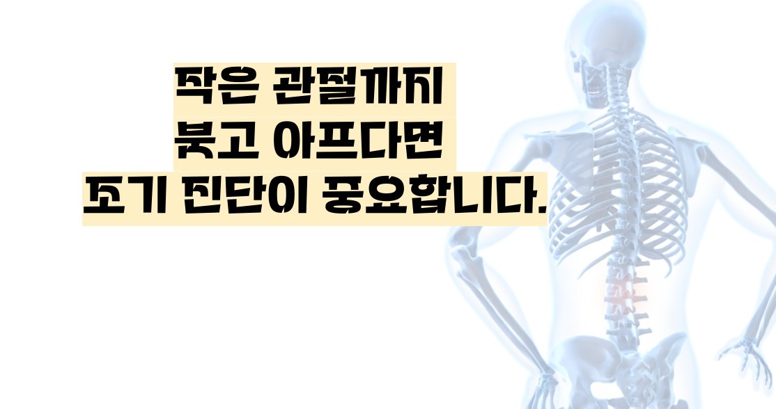 류마티스 관절염 초기증상