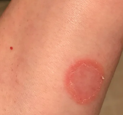 고양이 링웜 증상&amp;#44; 원인&amp;#44; 치료&amp;#44; 예방 총정리 원형탈모 무슨일?