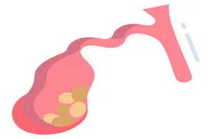 담석-제거-수술비용