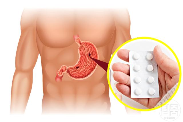 위염 증상 진통제