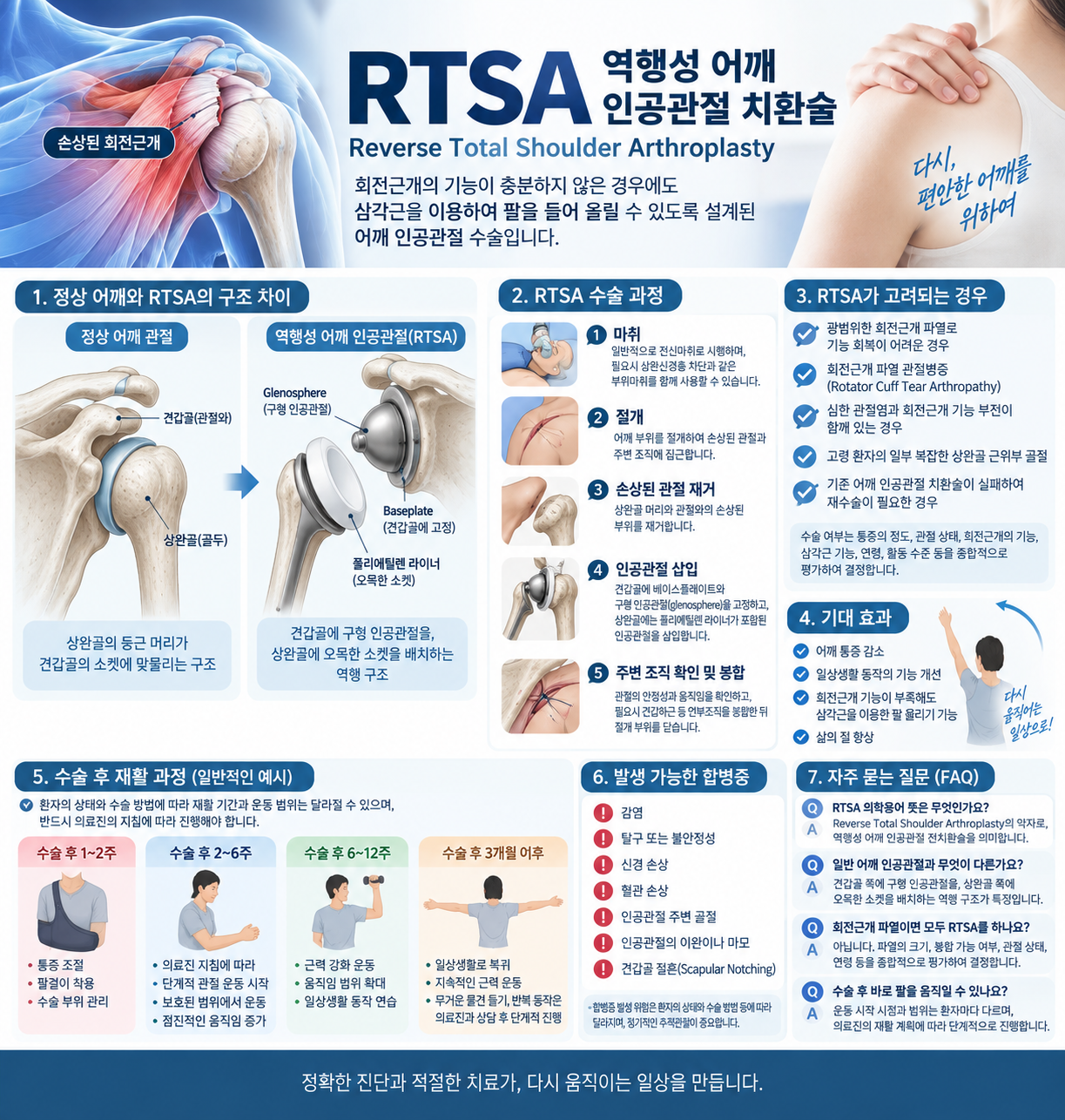 RTSA 의학용어 뜻은? 역행성 어깨 인공관절 수술 방법과 회복