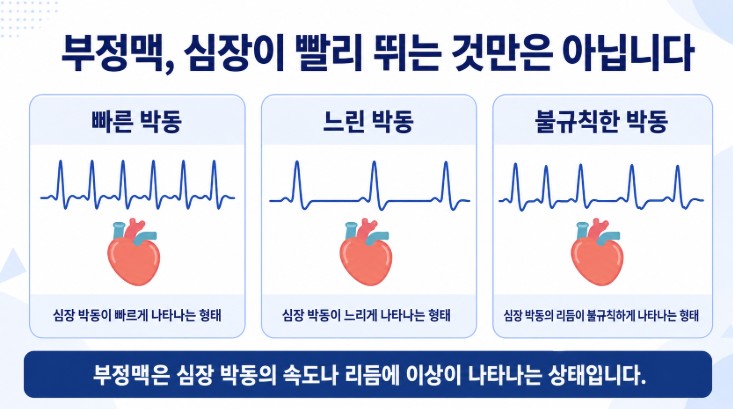부정맥에서 심장 박동이 빠르거나 느리거나 불규칙하게 나타날 수 있음을 설명하는 이미지