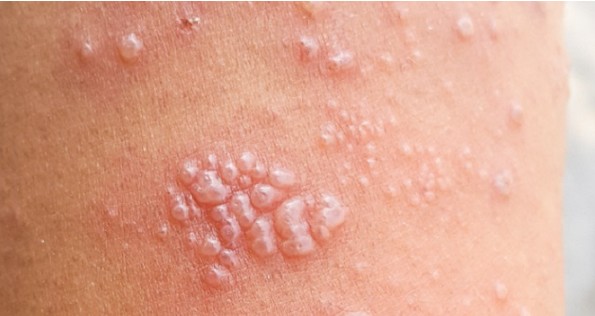 고통스런 발진을 일으키는 바이러스 감염 대상포진