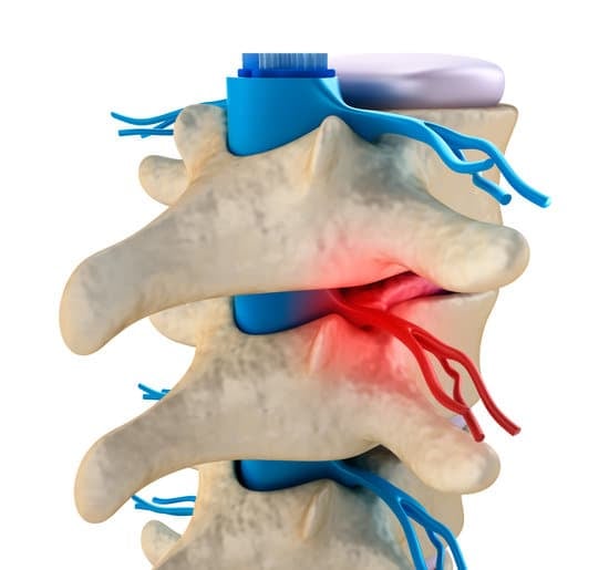 척추관 협착증(Spinal Stenosis): 원인, 증상, 치료 및 예방
