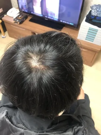 정수리가 아픈 이유와 완화하는 방법_6