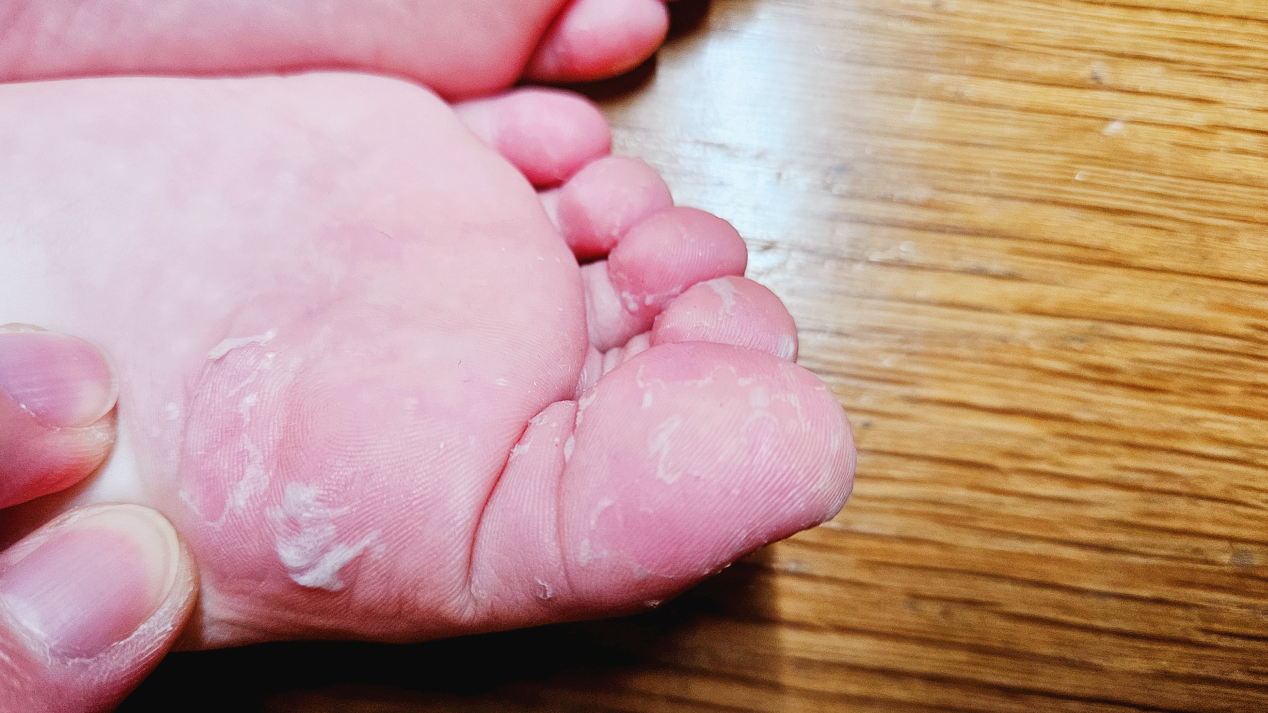 수족구 후유증