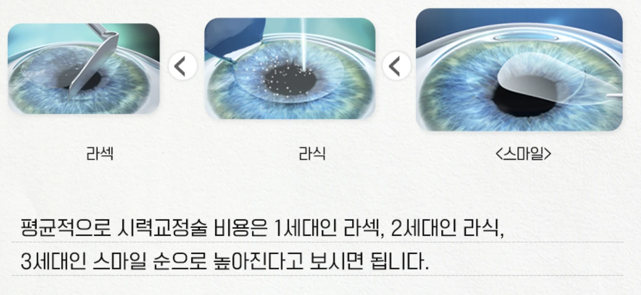 스마일라식 비용