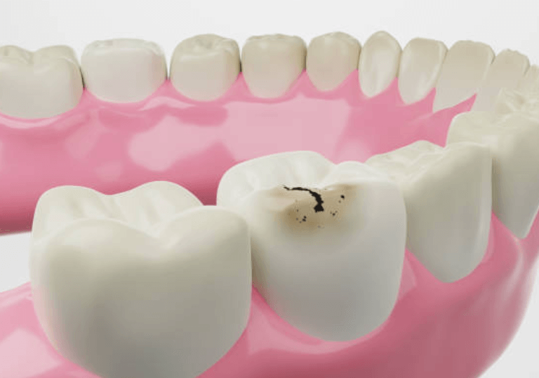 충치 치료 실비