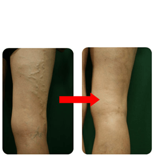 다리가-붓는-이유-하지정맥류-수술비용