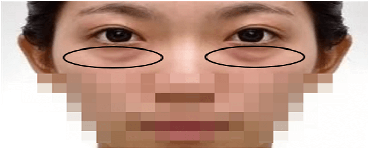 눈밑지방제거 전 사진