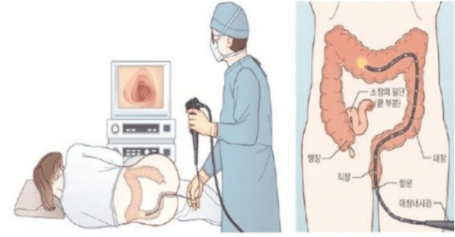 대장 용종 종류 원인 알아보기