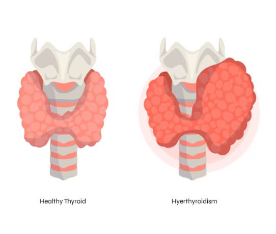 갑상선 기능 저하증 비교 분석