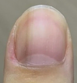 손톱에 검은 줄 증상,원인,치료법