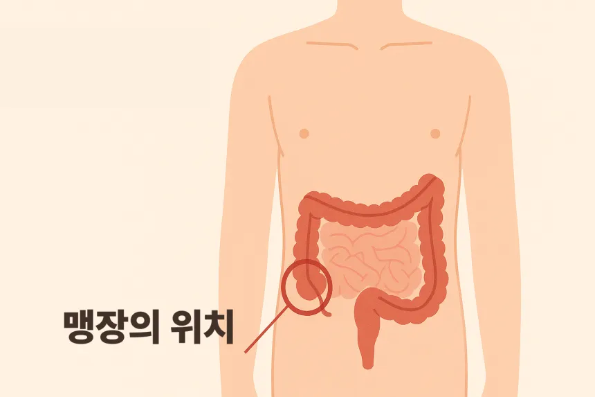 맹장염 초기증상