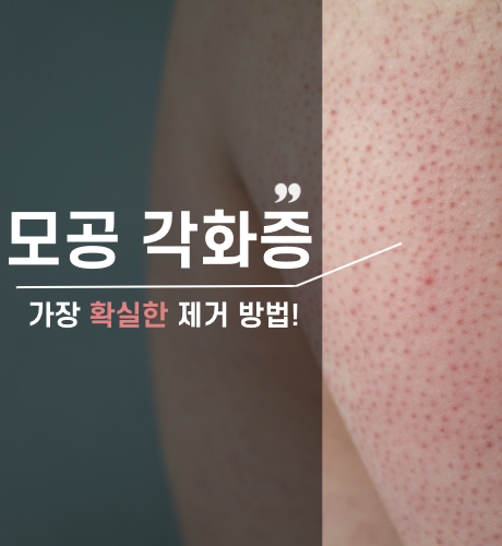 모공각화증 치료방법