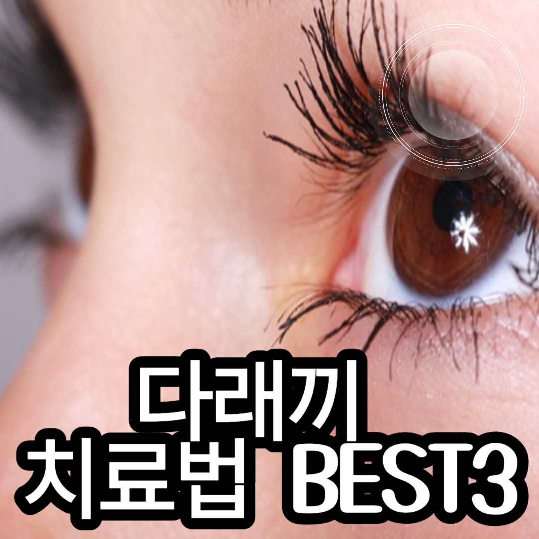 다래끼 원인&#44; 다래끼 치료&#44; 다래끼 약&#44; 다래끼 전염&#44; 다래끼 수술&#44; 다래끼 찜질&#44; 다래끼 안대&#44; 다래끼 증상&#44; 다래끼 고름&#44; 다래끼 병원&#44; 눈 다래끼