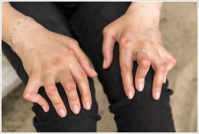 류마티스 관절염 초기증상