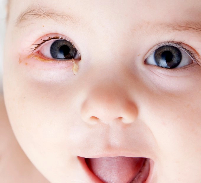 아데노바이러스 증상 전염 검사 등 눈꼽감기 완벽정리