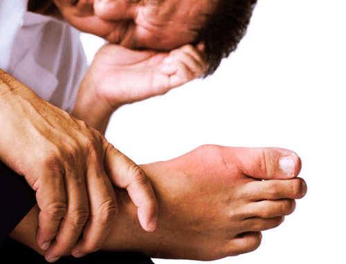 통풍으로 고생하는 남자