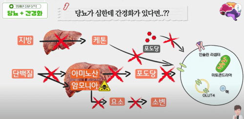 간경화와 당뇨의 합병증, 어떻게 극복할까?