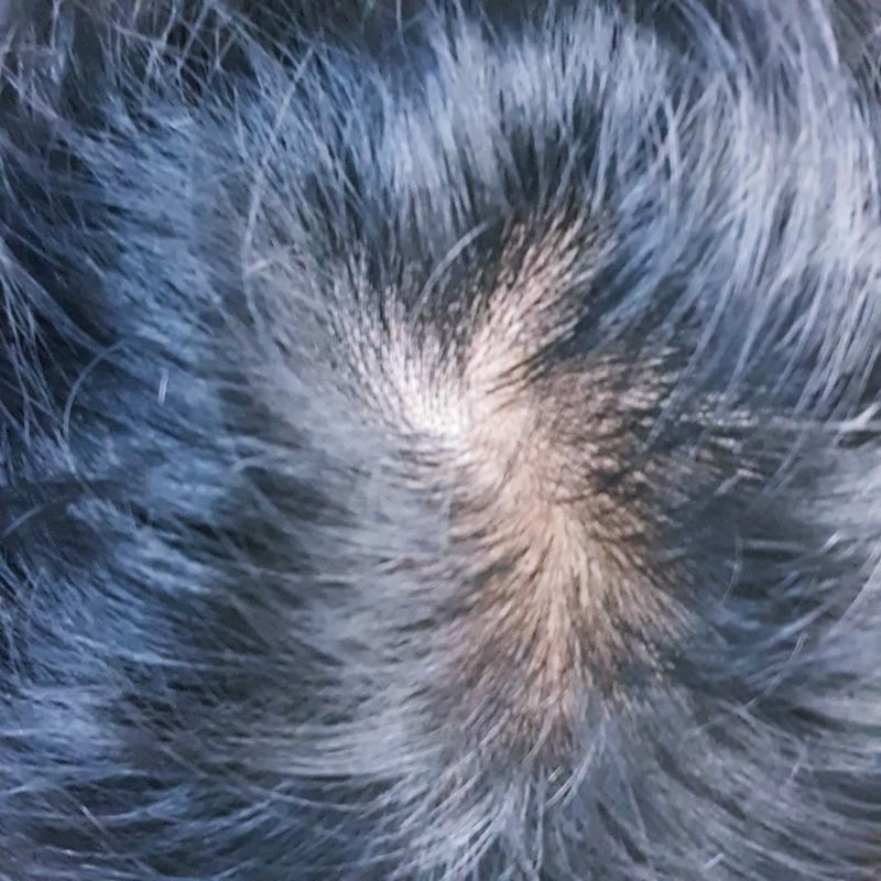 정수리가-휑한-두피의-모습