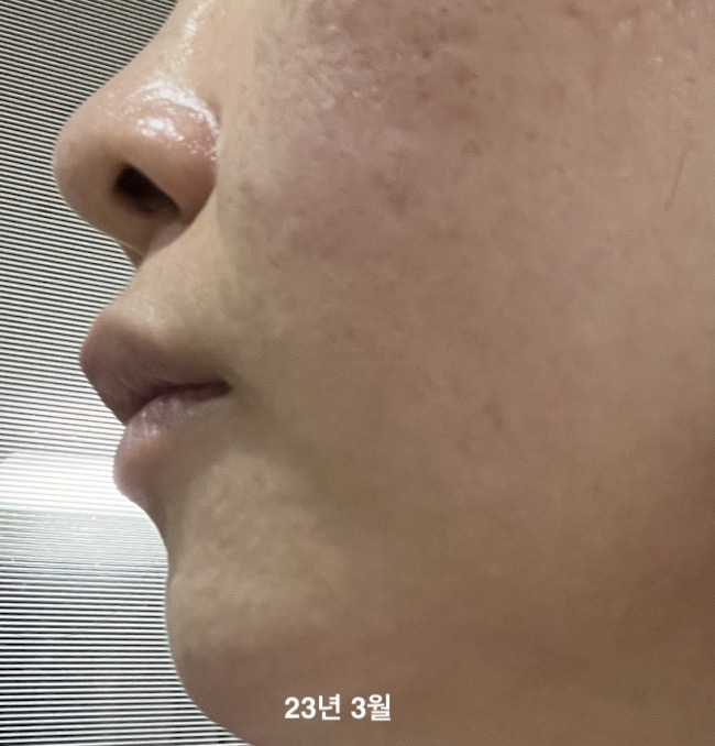 2년 7개월 교정 중 과개교합 돌출입 교정 일기