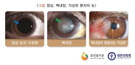 정상눈의 수정체(왼쪽), 백내장(가운데), 백내장과 혼동되는 익상편(오른쪽) 사진