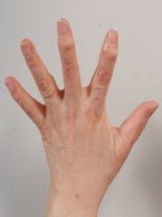 손가락 관절염 초기증상