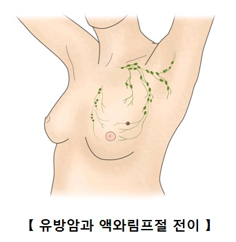 유방암 초기증상