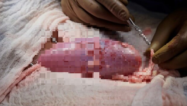 돼지-신장-이식