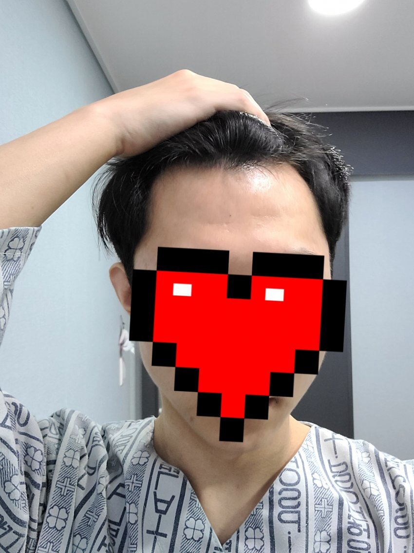 비절개모발이식후기