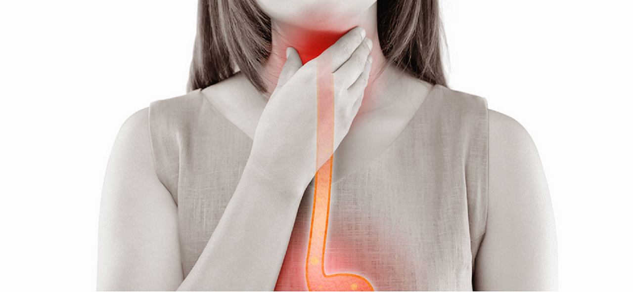 역류성 식도염 증상