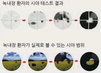 녹내장 진단 검사 비용 안압 검사주기 관리법_2