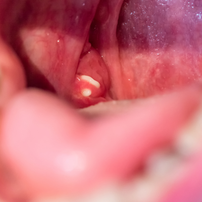 편도결석 뜻과 발생 원인, 증상 및 대처 방법