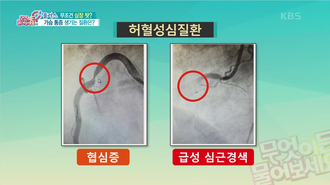 타는 듯한 통증 역류성식도염 심장질환 구분 및 쥐어짜는 듯 한 허혈성 심질환 협심증 심근경색 증상까지