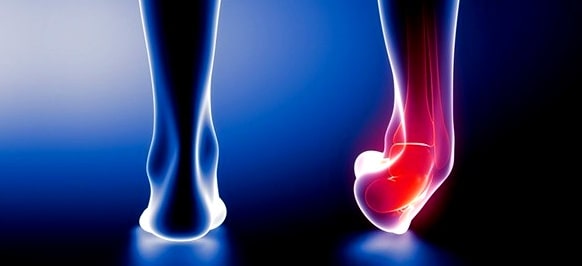 발목-삐었을때-빨리-낫는법