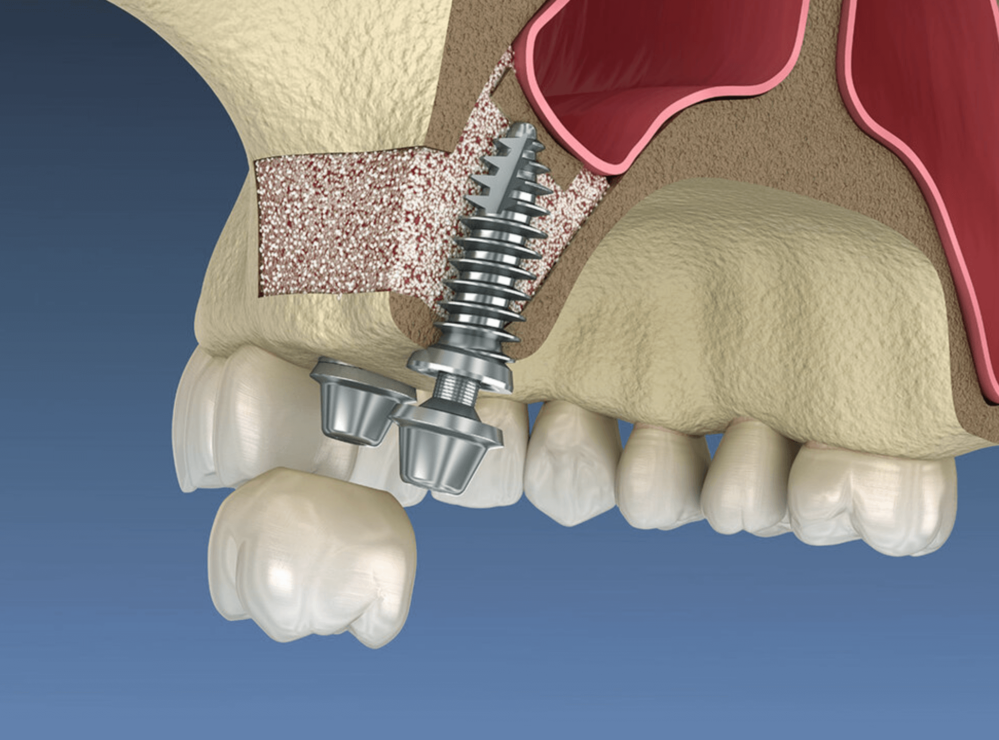 임플란트 상악동