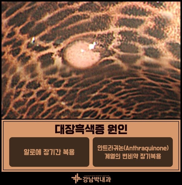 대장흑생증의 원인/ 출처 - 네이버블로그[내과박원장]