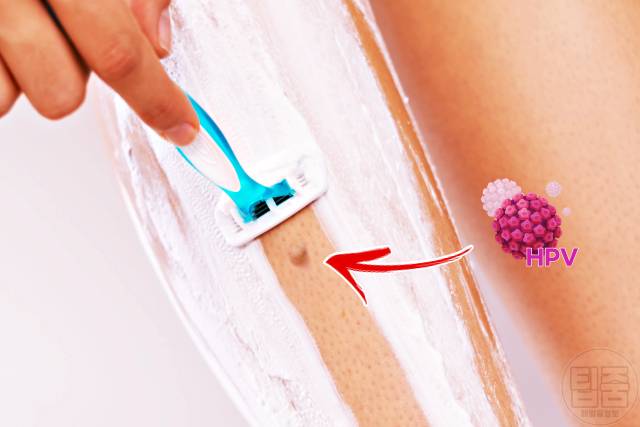 종아리 사마귀 제거 연고