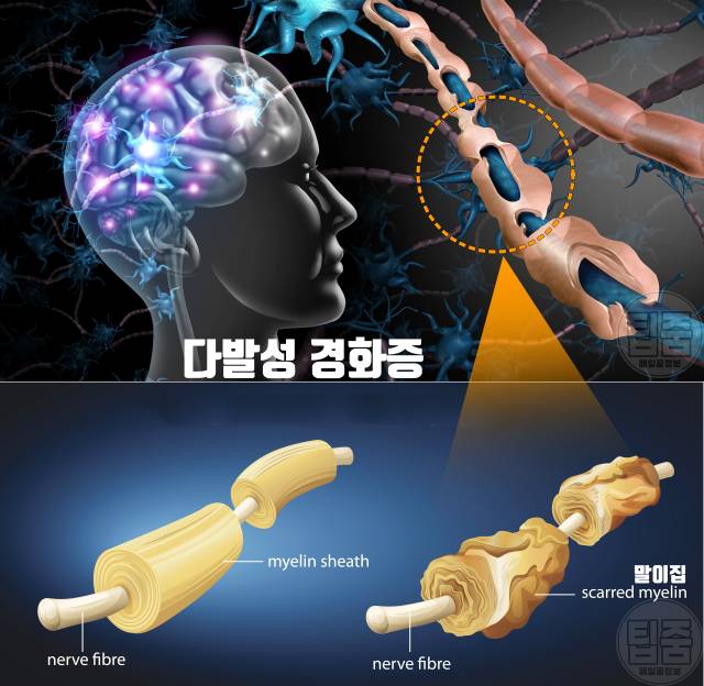 귀에서 삐소리 이명 증상 원인 다발성 경화증