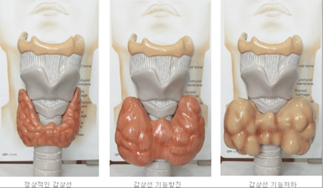 갑상선 기능 저하 사진