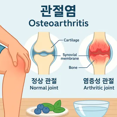 관절염 생기는 이유와 예방법: 관절 통증 원인, 관절염 치료 방법