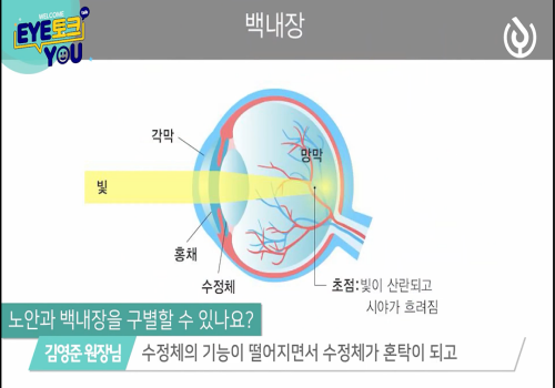 백내장 증상