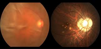 비문증 치료방법