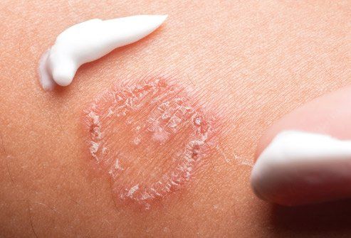 피부 발진 종류