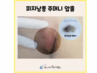 엉덩이 종기가 생기는 이유 왜 생기고 어떻게 관리할까요 완벽 가이드_3