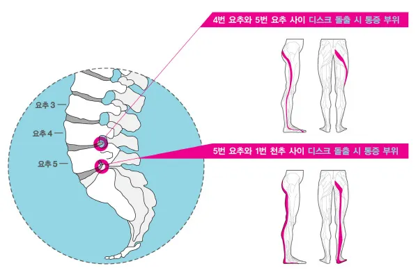 4번 5번 사이 디스크