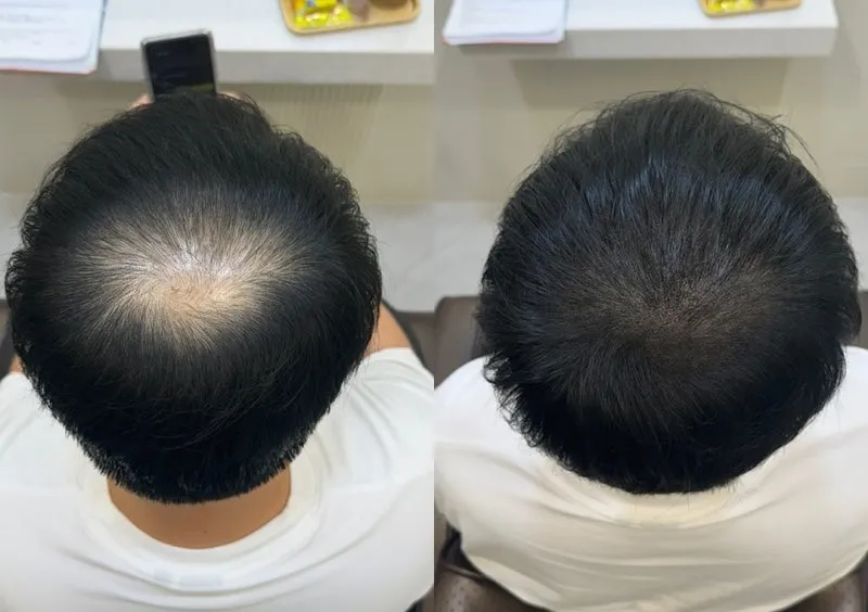 정수리가 아픈 이유와 완화하는 방법_5