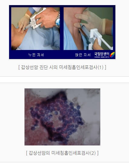 갑상선암 진단 검사